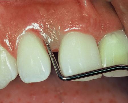 treatment of periodontitis of teeth