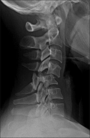 fracture of 6 cervical vertebra 